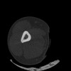 SPORK, NICO - 22.03.1976 - 02.08.2022 - CT obere Extremität - 17:51:17
